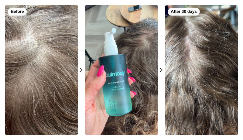Anti Dandruff | Scalp treatment